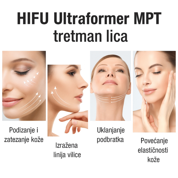 HIFU Ultrafomer MPT tretman lica