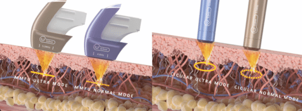 HIFU ultraformer-MPT