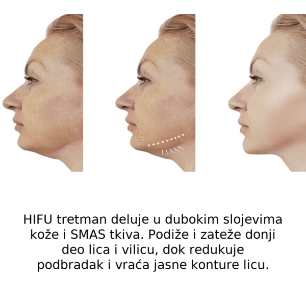 HIFU_tretman_donji deo lica i podbradak