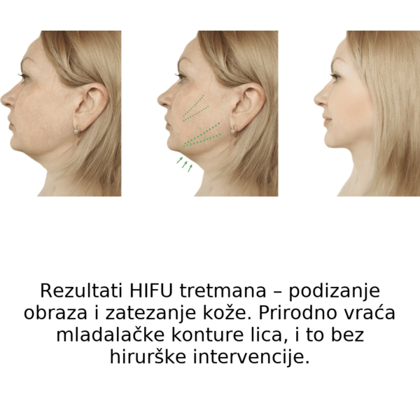 HIFU_tretman_podizanje obraza