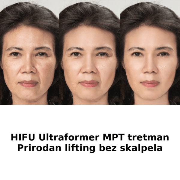 HIFU_tretman_prirodni lifting