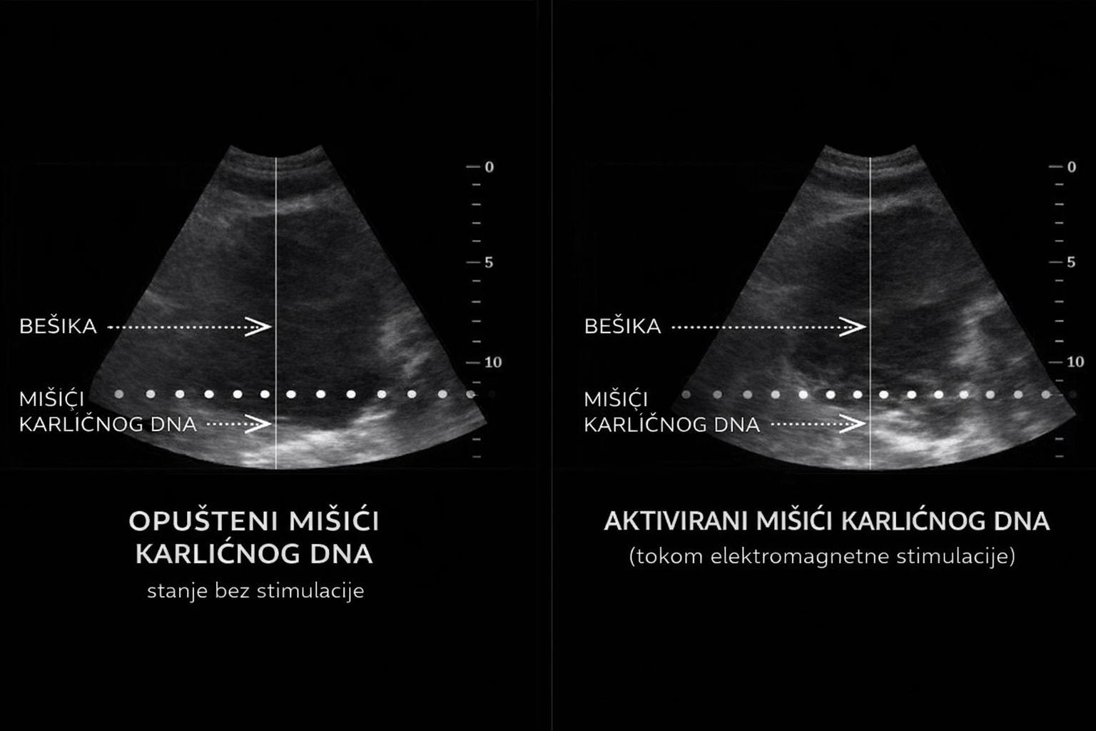 Ilustracija aktivacije mišića karličnog dna tokom elektromagnetne stimulacije